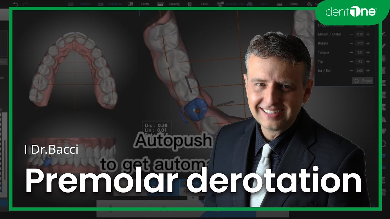 #2 Premolar derotation