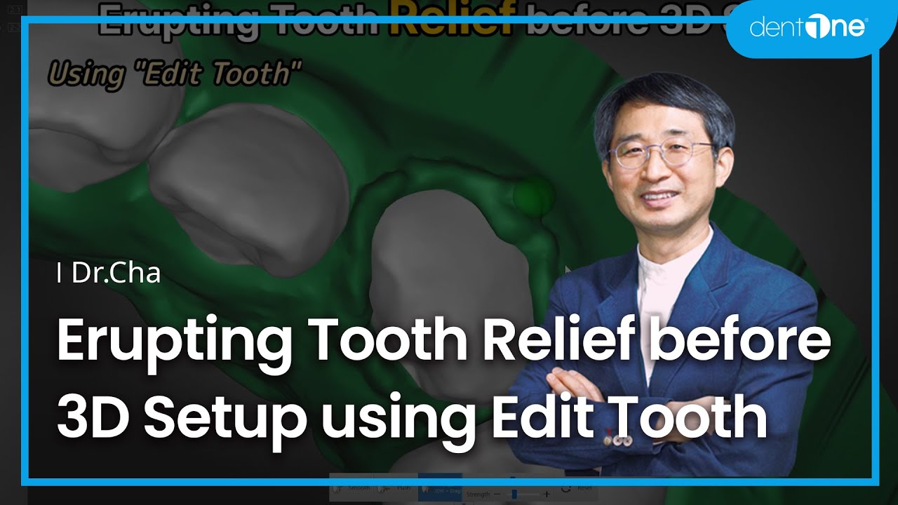 #4 Erupting Tooth Relief before 3D Setup using Edit Tooth