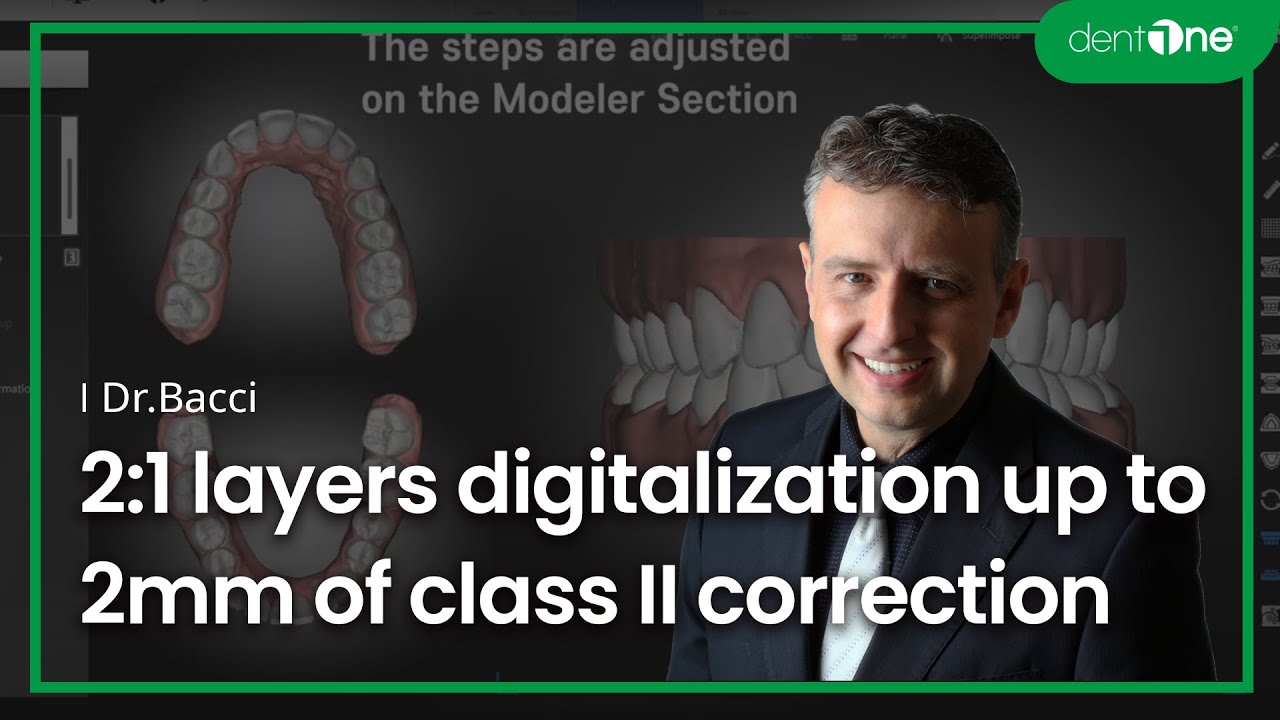 #4 2:1 layers digitalization up to 2mm of class II correction