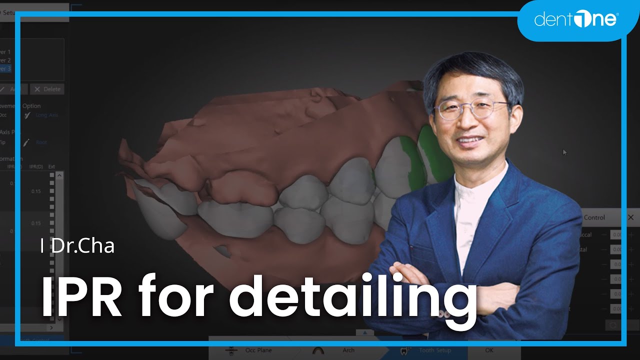 #3 Relapse - IPR for detailing